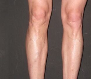 Veniselle a aidé à se débarrasser des varices