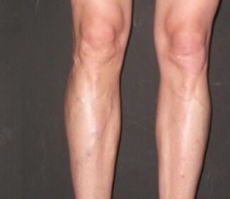Veniselle a contribué à se débarrasser des varices