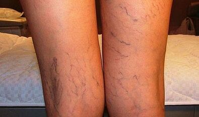 Symptômes des varices chez les femmes