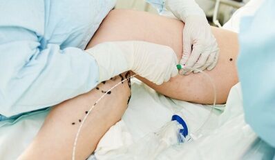 Méthodes de traitement des varices sur les jambes chez les femmes