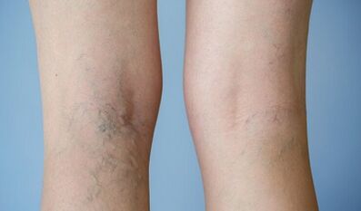 Signes de varices sur les jambes chez les femmes