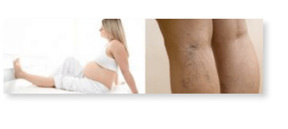 Recommandations pour les varices chez la femme enceinte