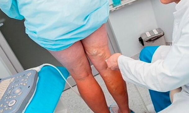 Diagnostic des varices des jambes