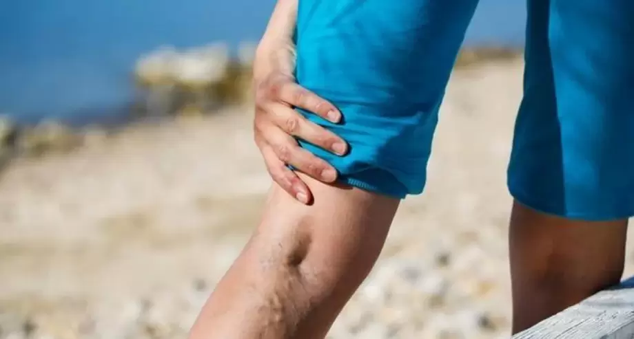 Varices sur les jambes
