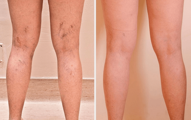 Jambes avant et après traitement des varices