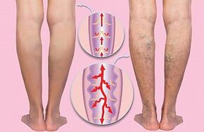 Varices des membres inférieurs