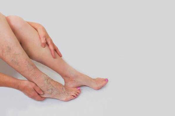 Les veines dilatées saillantes sont un signe de varices dans les membres inférieurs