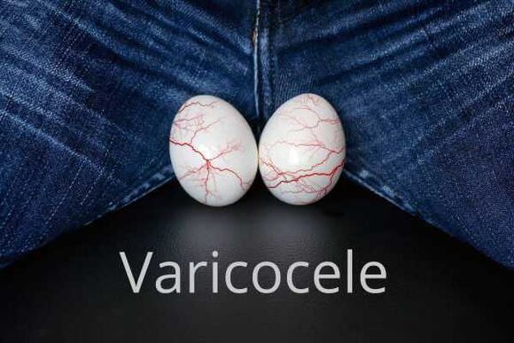 Varicocèle – hypertrophie des veines du cordon spermatique